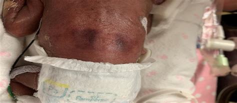 Neonatal Skin Structure: Pressure Injury Staging Challenges.